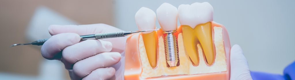 Dental Restoration Services