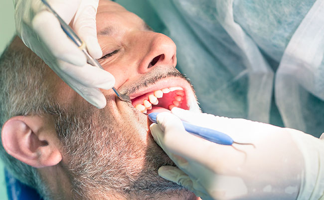 Full Mouth Debridement Cleaning