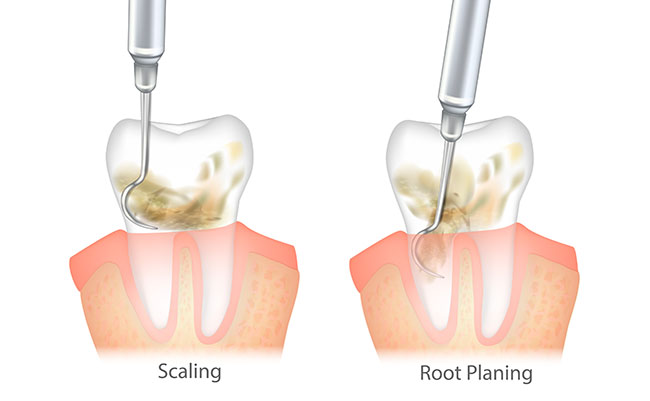 Dental Scaling and Root Planing